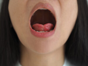 ankyloglossia in asian woman and cause of an unusually short of tissue tethers the bottom of the tongue to the floor of the mouth on isolated white background