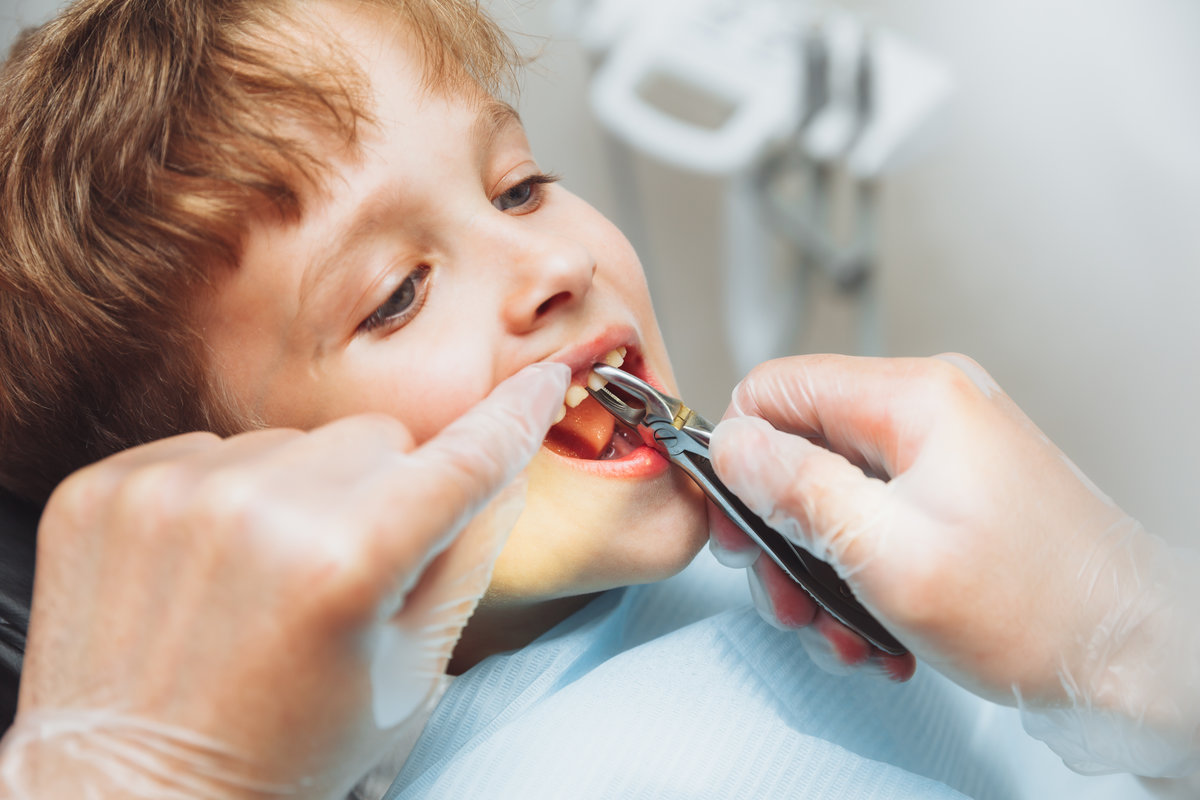 Portrait of a child patient and the hands of a pediatric dentist with dental forceps, close-up. painless extraction of teeth. pediatric dentistry.